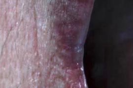 Treatment of Venous-Lake Angioma with Pulsed Light - After Photo