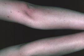 Leg Hair Removal Treatment - After Photo