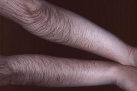 Leg Hair Removal Treatment - Before Photo