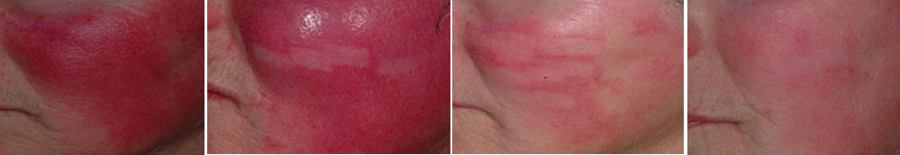 Photo of Rosacea and Dramatic clearing of Facial Redness as a result of treatment