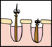 Pulsed Light or Lasers Animated Explanation