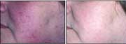 Rosacea - Cheek