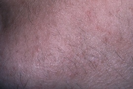 Left chin - After