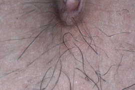 Abdomen - Before