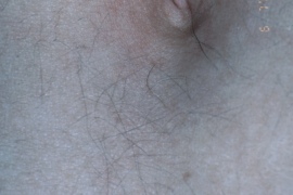 Abdomen - After