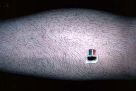 Right calf - Before