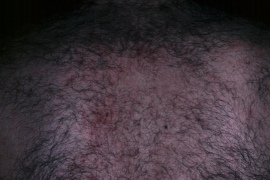 Back hair laser hair removal treatment by MD - Before Photo