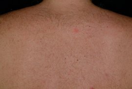 Back hair laser hair removal treatment by MD- after photo