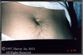 abdomen of a 19 year old female - before