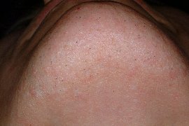 chin of 42 year old female - After