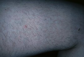 Inner thigh - before