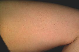 Inner thigh - After