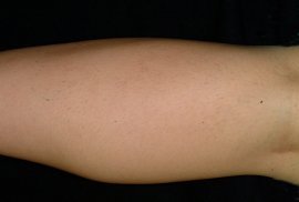 Calf of 30 yr old female - after