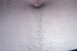 Abdomen of female - Before