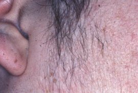 Sideburn of 45 yr old female - Before