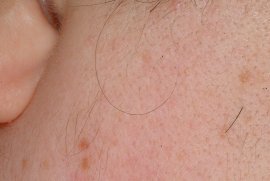 Sideburn of 45 yr old female - After