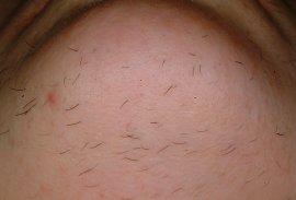 Chin of 45 yr old female - After