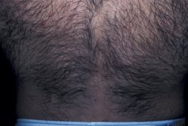 male lowerback - Before