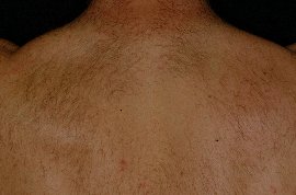 Upperback of male  - After