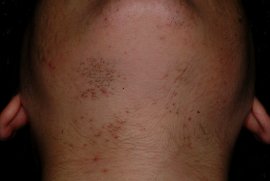 Chin and neck - Before