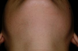 Chin and neck - After