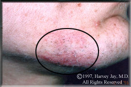 Right chin - Before