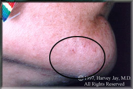 Right chin - After