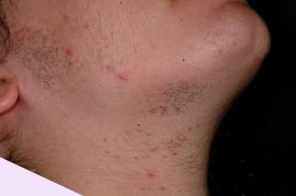 Face and neck of 25 year old female - Before