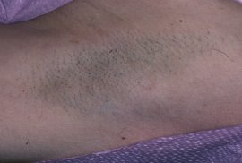 Underarm of 30 year old female - Before