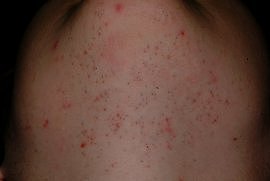 Polycystic Ovarian Syndrome Chin - Before