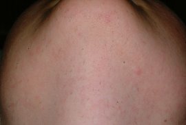 Polycystic Ovarian Syndrome Chin - After