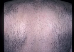 Male Back Hair Removal - Before
