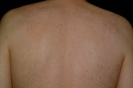 Male Back Hair Removal - After