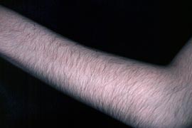 Sixteen Year Old Female - Before