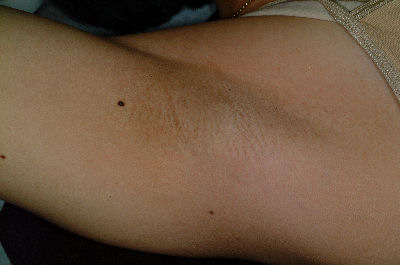 Underarm - After