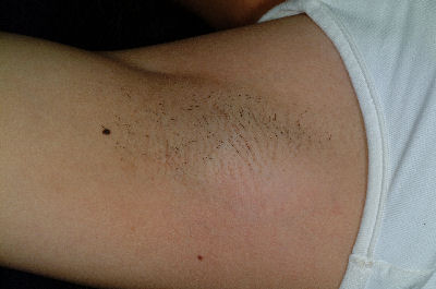 Underarm - Before