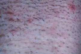Pseudofolliculitis barbae - After