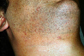 Shaving Bumps Intense Pulsed Light Treatmen By Md