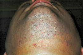 clearing of ingrown hairs under Chin - After