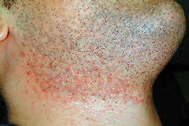 Neck Ingrown Hair