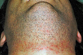 Shaving Bumps Intense Pulsed Light Treatmen By Md