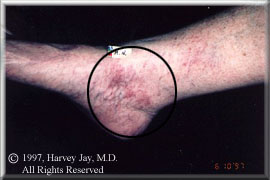 blood vessels on right foot - Before