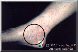blood vessels on right foot - After