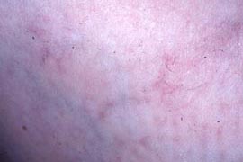 Close up of patient - After