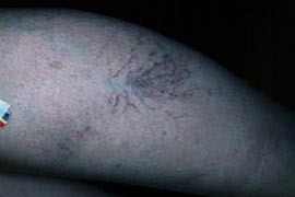 photoderm for leg veins - Before