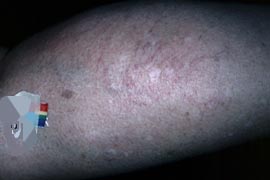 photoderm for leg veins - After