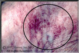 blood vessels on foot - Before