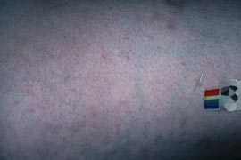 blood vessel removal - After