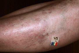 spider vein treatment - Before