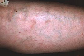 leg veins - After